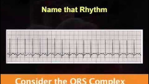 Introduction to EKG Rhythm Interpretation (Part 2)