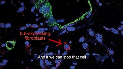 Why is pancreatic cancer SO hard to treat? New discovery helps explain