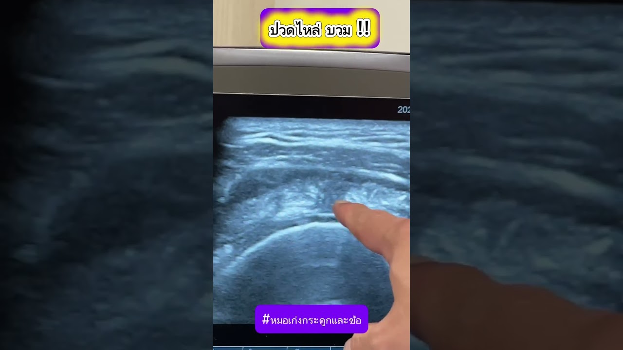 ปวดไหล่ บวม !!