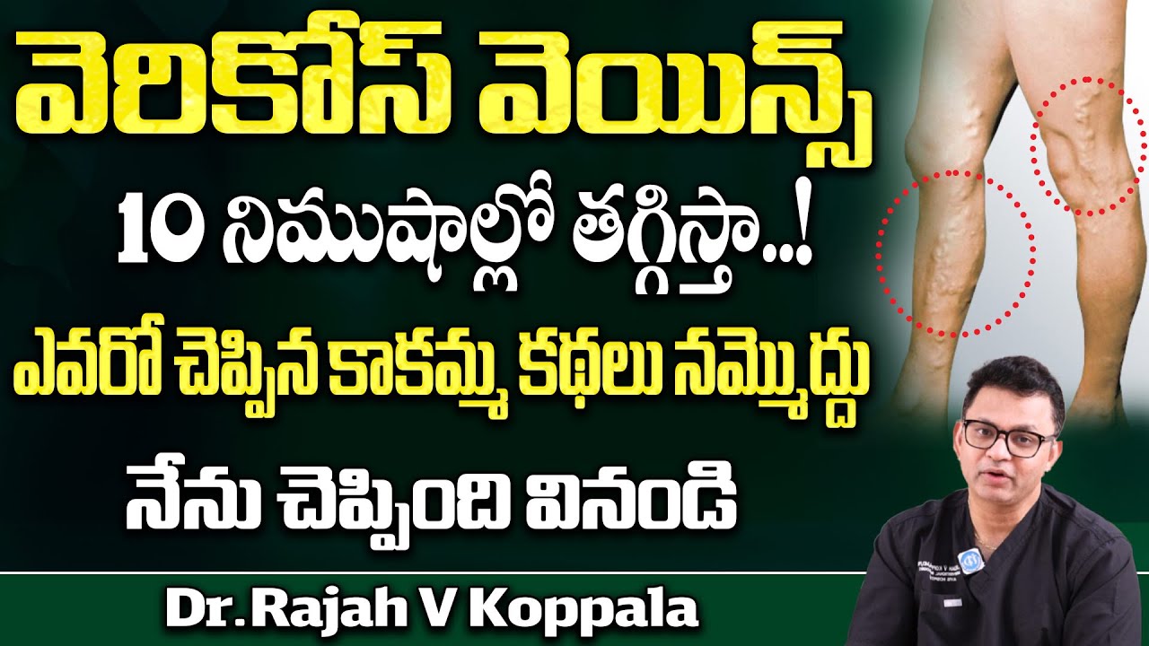 వెరికోస్ వెయిన్స్ 10 నిముషాల్లో తగ్గిస్తా..! | Varicose Veins Symptoms and Causes, Treatment