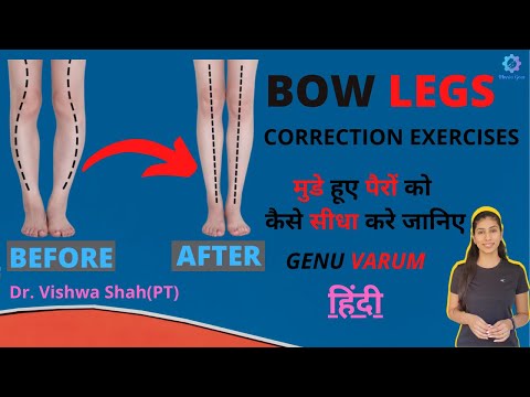 Bow Legs Correction Exercises | Bow knees workout | Knee pain relief treatment| Genu Varum Arthritis