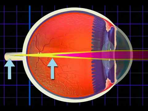 Video: Astigmatizam Oka - Pojmovnik Medicinskih Pojmova