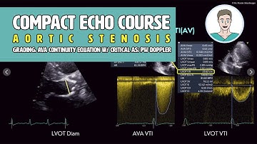 〖Echocardiography〗 Quantification of aortic stenosis - all the numbers🫀