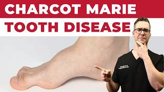 Charcot Marie Tooth Disease [Best Foot Treatment!]