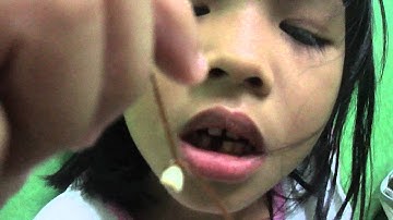 milk teeth removed by using thread