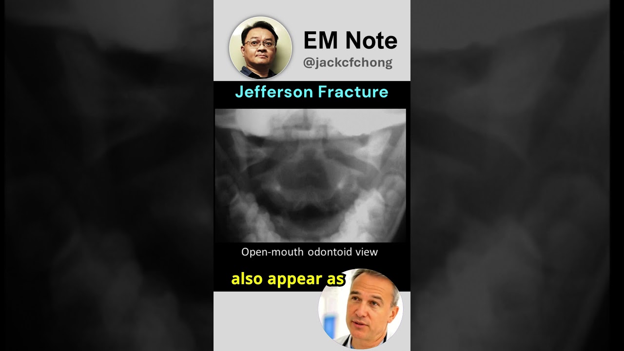Jefferson Fracture