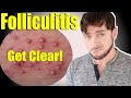 Folliculitis Skin Bumps | Get Clear Skin and Scalp | Causes and Cures