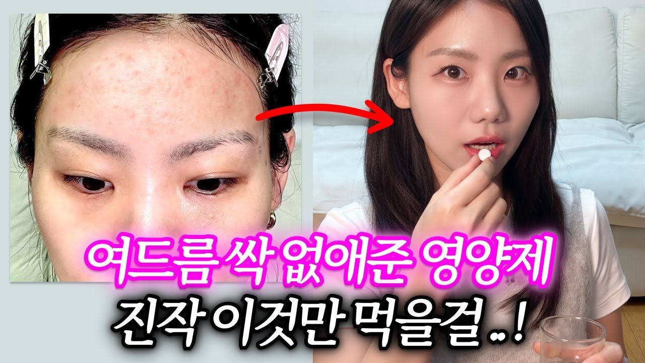 지긋지긋한 여드름 피부에서 꿀피부 만들어준 영양제. 제발 1달만 따라해보세요!!!!