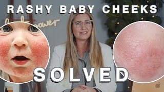 Red Rashy Baby Cheeks | Skin Deep