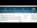 Easy EKG: Interpreting Rhythms