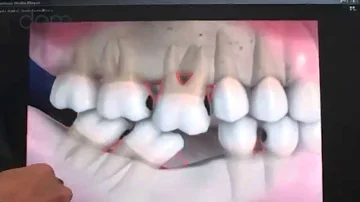 Quais os problemas que a falta de dentes pode causar?