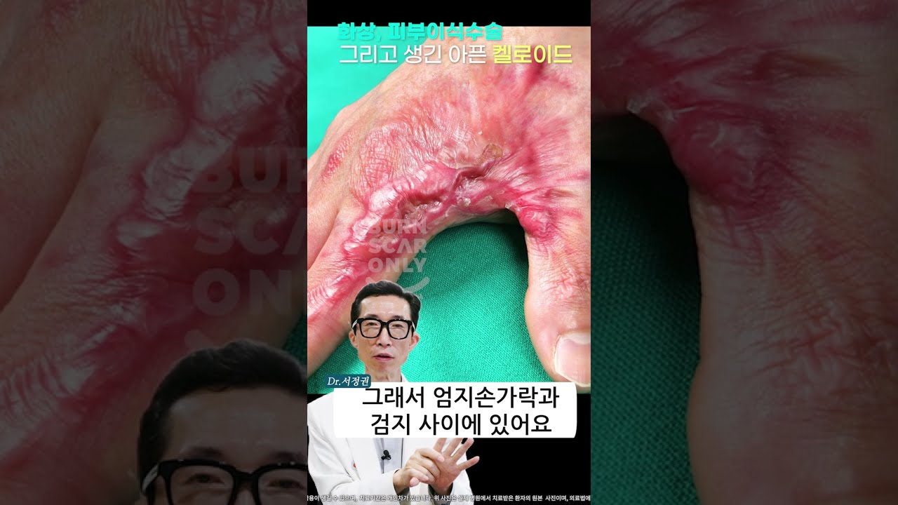 핀홀셀 치료 2회만에 아프고 간지러웠던 켈로이드 증상이 사라졌습니다