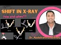How and When to do mesial & distal shift || Dr. Abdelrahman Elkholy