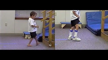 Before and After: excess dorsiflexion | DAFO Turbo | Cascade Dafo