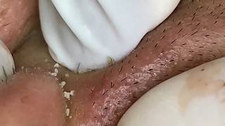 Extreme Blackhead Extraction - Close Up Pore Cleansing at Luxury Spa