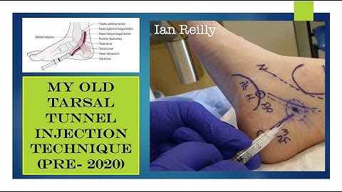 My old tarsal tunnel syndrome injection technique