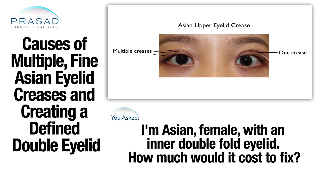 Turning Several Small Eyelid Creases into an Asian Double Eyelid