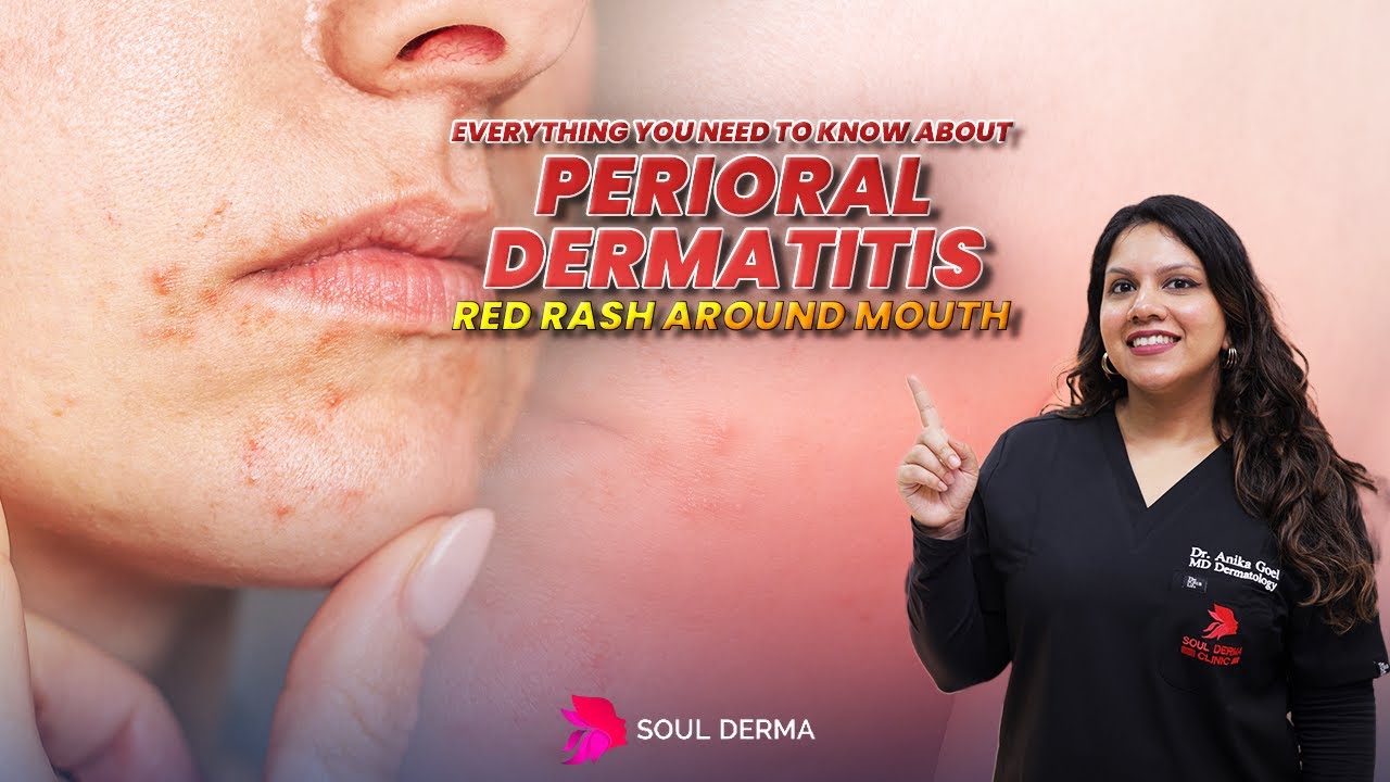 perioraldermatitis-causes-symptoms-treatment-for-red-rash-around