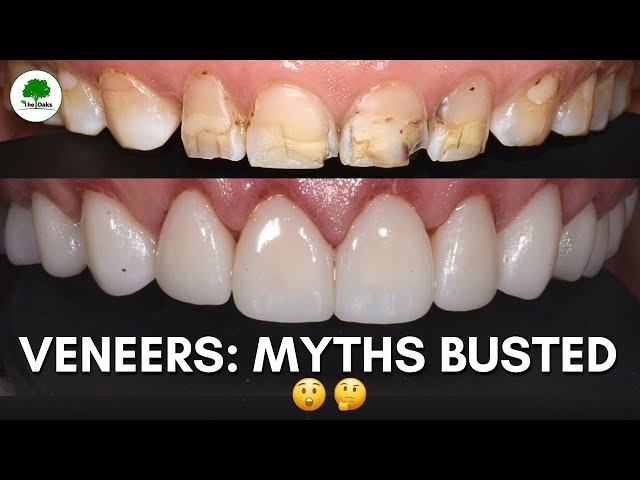 The Modern Veneer Revolution