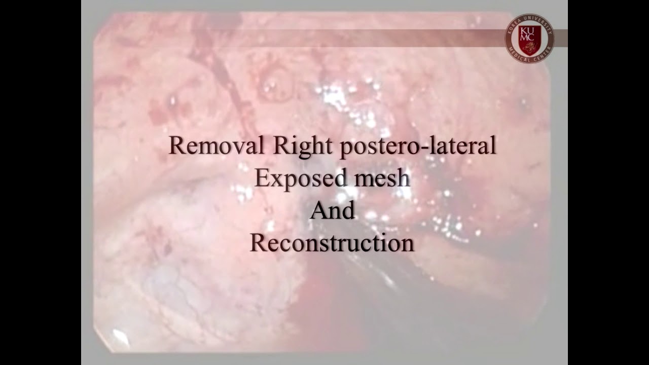 ICS 2018 Abstract 638 Laparoscopic transvesical excision and