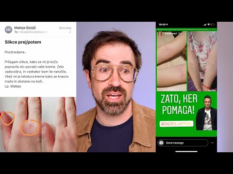 Video: Dieta Za Atopijski Dermatitis, Seboroični - Meni