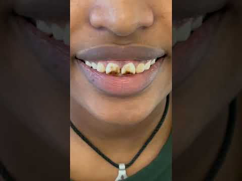 #porcelainveneer process with Dr. Tejas Patel