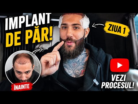 MI-AM FACUT IMPLANT DE PĂR, PENTRU PRIMA OARĂ ÎN VIAȚA MEA !!