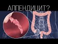 Что такое аппендицит? Все про Аппендикс | ПОЛЕЗНЫЙ ЮТУБ