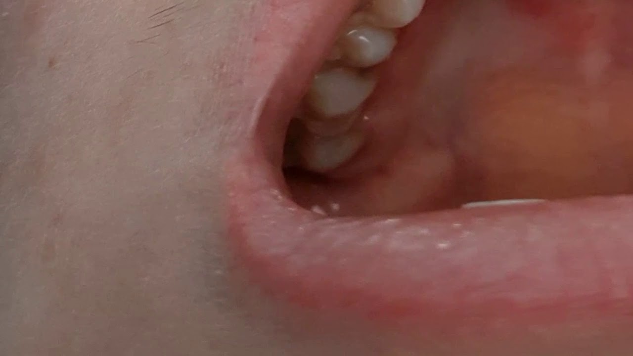 прыщ на небе что делать, прыщи на нёбе во рту - YouTube