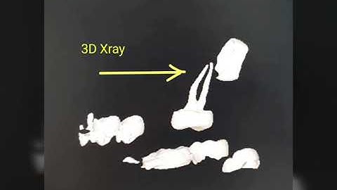 2D Xray vs 3D Xray 