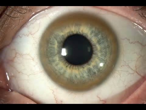 Choosing a Cataract Surgeon | Richardson Texas