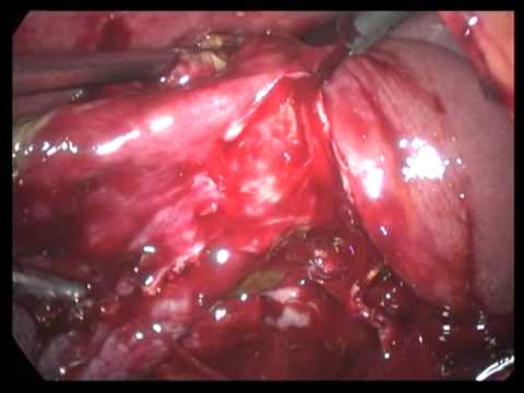 Laparoscopic Cholecystectomy (unedited-63)-Acute Gangrenous Cholecystitis Perforated, Bad Case