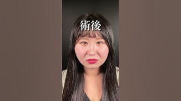 【全顔整形】整形後は垢抜けた雰囲気になりましたね✨　#shorts