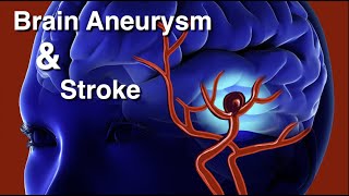 Brain aneurysm and stroke What S The Difference Between Aneurysm And Stroke