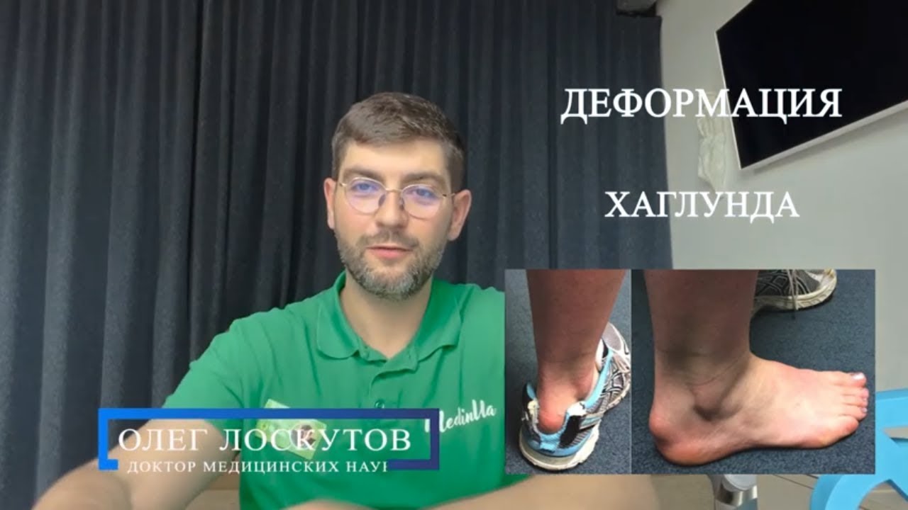 Бурсит ахиллова сухожилия