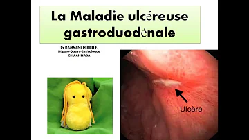 Che cos'è l'ulcera gastroduodenale?