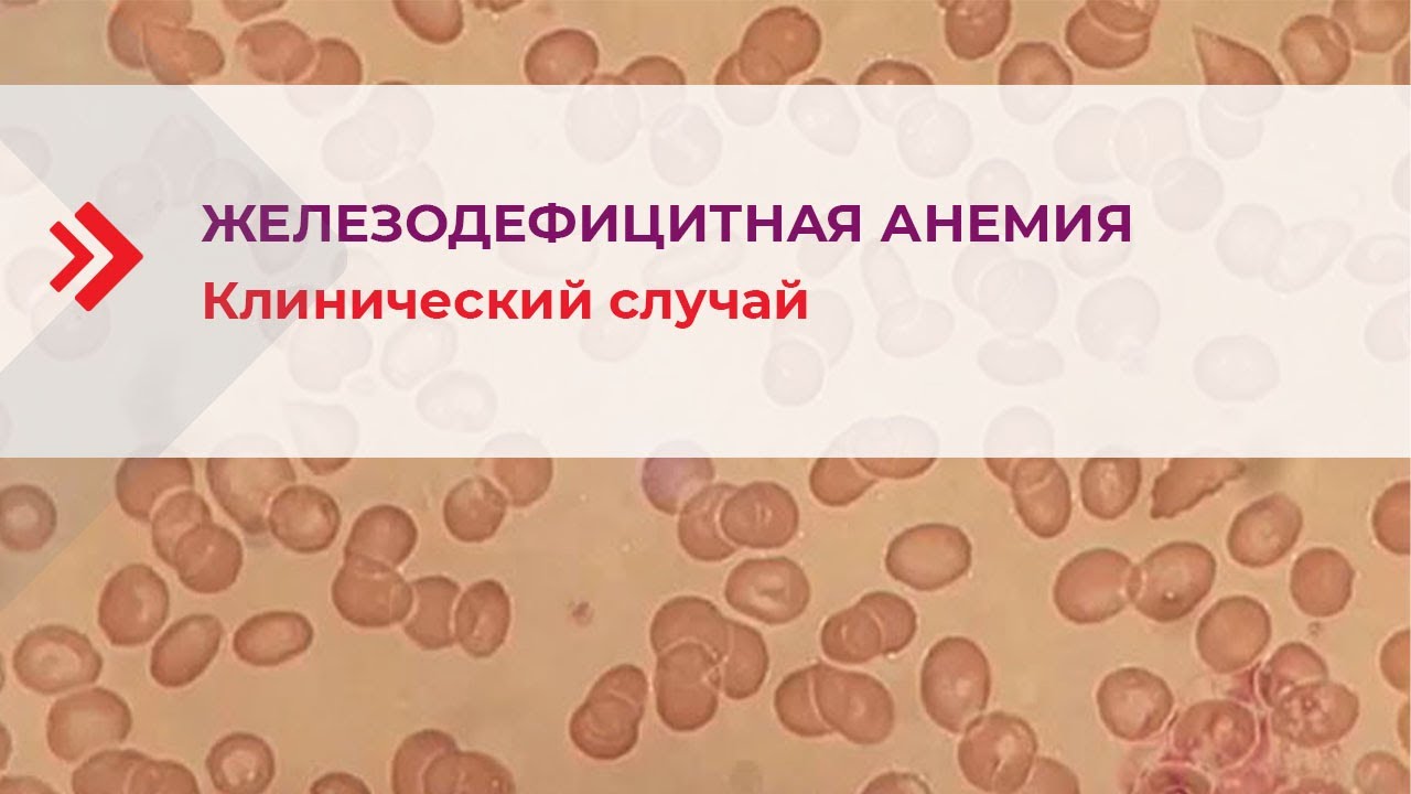 Железодефицитная анемия. Клинический случай - YouTube