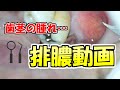 【閲覧注意】歯に溜まった膿をだす