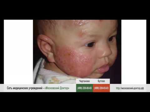 Виды аллергии у детей Виды аллергии у детей