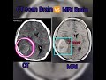 CT scan Brain 🆚 MRI Brain/Pathology detailing #aiims