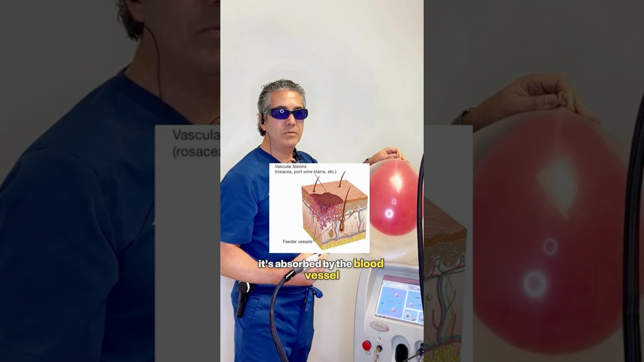 Laser vs Redness –What ACTUALLY Happens in Real Time! #lasertreatment #rosacea