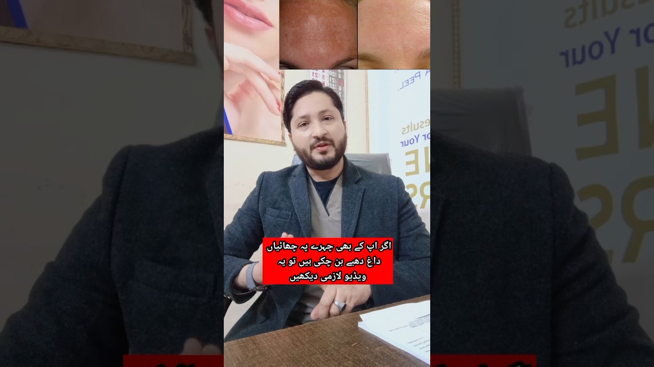 face Melasma treatment | #melasma #shortvideo #trending #viralshortvideo