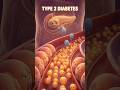 How Sugar Causes Insulin Resistance and Type 2 Diabetes Explained