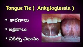 Tongue Tie | Ankyloglossia Causes, Symptoms and treatment in Telugu.