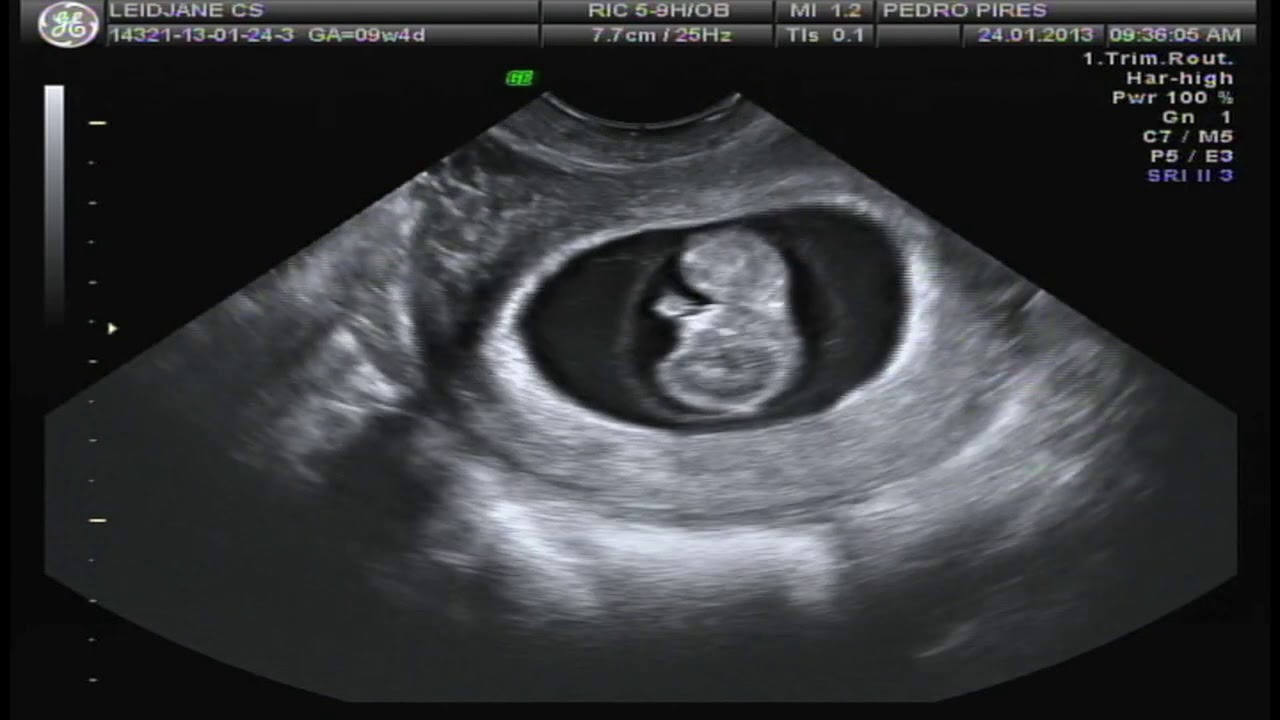 Download FIRST PREGNANCY ULTRASOUND (Gender "confirmed" with 9 weeks?)