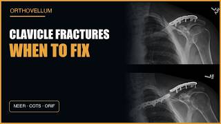 Clavicle Fractures Masterclass: Classification, Neer, COTS & ORIF Indications
