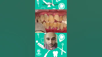 تنظيف جير الأسنان قبل وبعد وأضرار جير الأسنان 