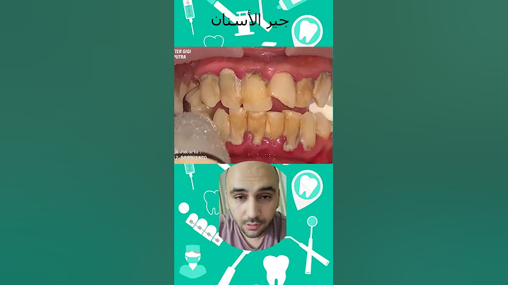 تنظيف جير الأسنان قبل وبعد وأضرار جير الأسنان.