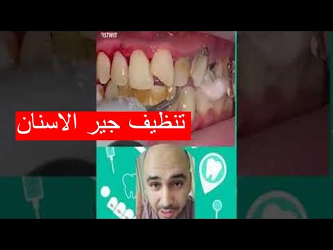 فيديو: كيفية إزالة الجير: 10 خطوات (بالصور)