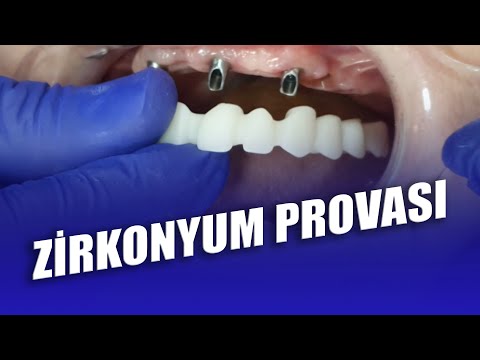 Zirkonyum Provası Nasıl Yapılır? İmplant Üstü Zirkonyum Kaplama Provası